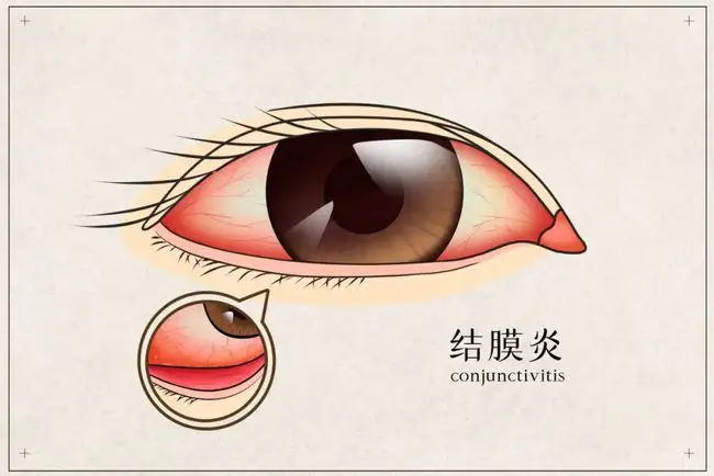 皮膚癢、拉肚子、腸胃不適、感冒，春夏換季病，艾灸來(lái)搞定！